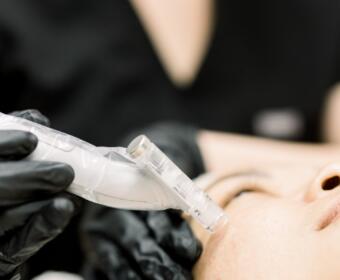 Microneedling at Bella Med Spa. (Contributed)