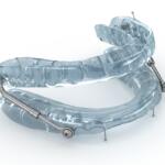 Oral appliance to treat sleep apnea.