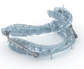 Oral appliance to treat sleep apnea.